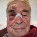 Peter suffered cuts on his nose, a laceration on his forehead and a black eye when he fell in Belper.