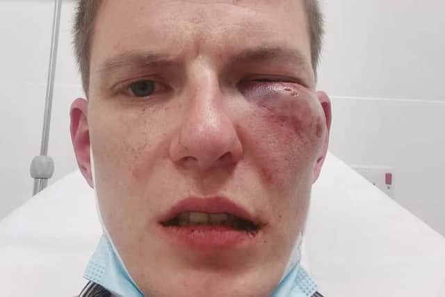 Peter Domanic was left with a broken cheekbone and cuts to his face and body after he was assaulted outside McDonald's in Barlborough on June 5.