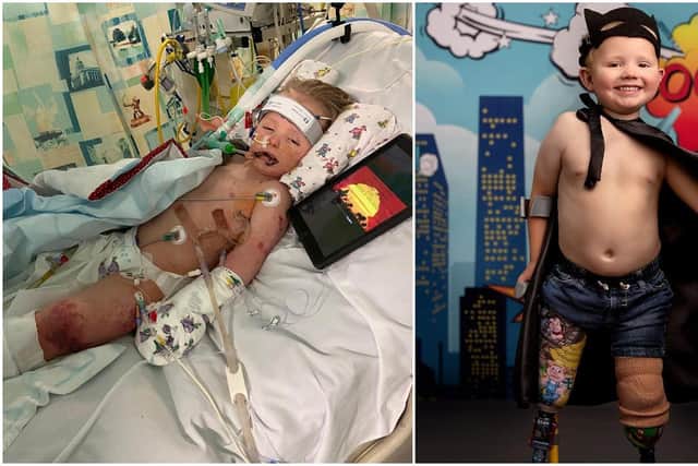 (Left) William was in hospital for other three months (Right) He's finally learning to walk and smile again- pic by Dinky Feet.