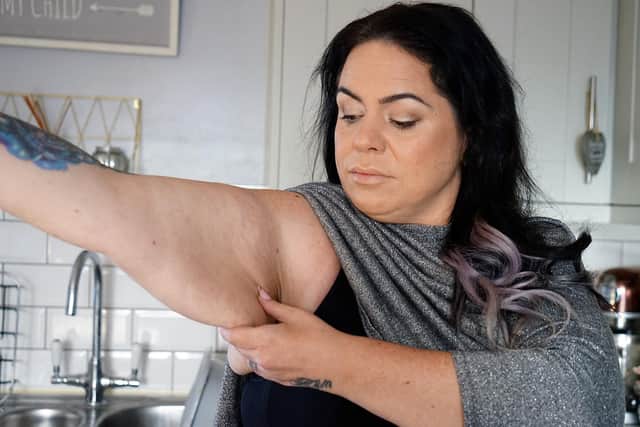 Tara has loose skin on the top of her arms, thighs and on her tummy as the result of her 12st weight loss.