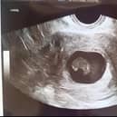 The scan taken when Ellie was 11 weeks pregnant and told the baby had not survived