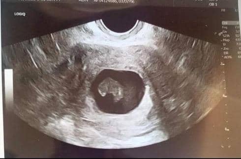 The scan taken when Ellie was 11 weeks pregnant and told the baby had not survived