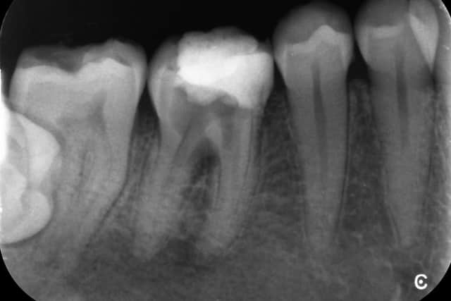 An X-Ray showing Kieran's damaged molar.