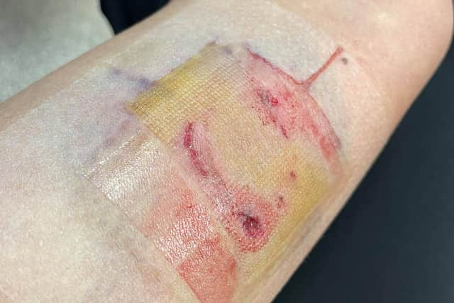 Alix Cooper has shared this picture of her wound.