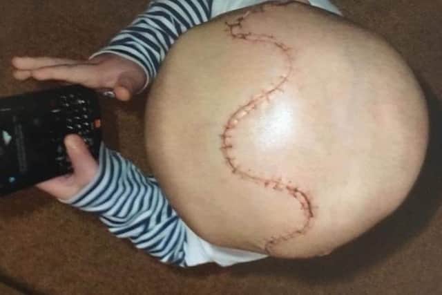 Daniel Bradley was born with craniosynostosis and underwent life-saving surgery at just one-year-old