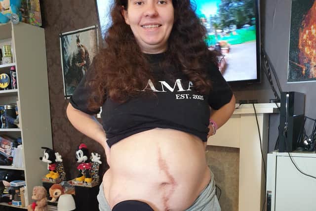Maria, pictured, has undergone over 30 operations throughout her life including having a stoma bag fitted