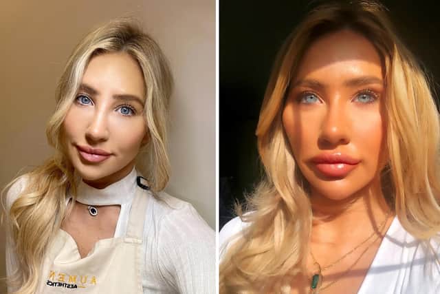 Emily Spence now (L) and in 2018 when she got her lip filler built up to 5ml, and had jaw, chin and cheek fillers - spending £5,000 on the lot.