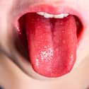 Scarlet fever is a highly contagious infection caused by the Strep A bacteria. Symptoms include a sandpapery skin rash and a white coating on the tongue.