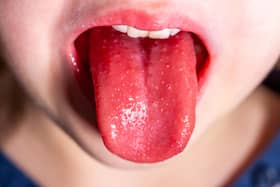 Scarlet fever is a highly contagious infection caused by the Strep A bacteria. Symptoms include a sandpapery skin rash and a white coating on the tongue.