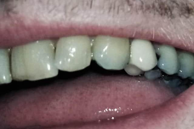The damage to Mr Georgeson's teeth.