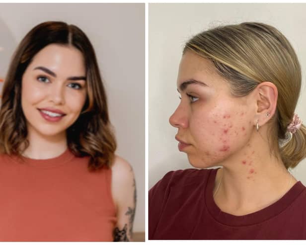 Faye Knox, left, at her Faye K Face Skin Clinic at Chatsworth Road  which she opened exactly two years ago this week. Her own experiences of acne are highlighted in the photo on the right.