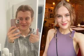 Rebecca Chadwick, 29, went ahead with the procedures to help boost her confidence after comparing her receding hairline to her sister's.