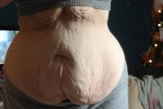 Following her incredible weight loss Clara has been left her with excess loose skin, weighing around 25lbs, which she is now hoping to get surgically removed