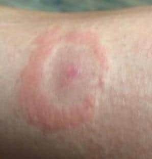 EM skin rash caused by Lyme disease. Image credit – Lyme Disease UK