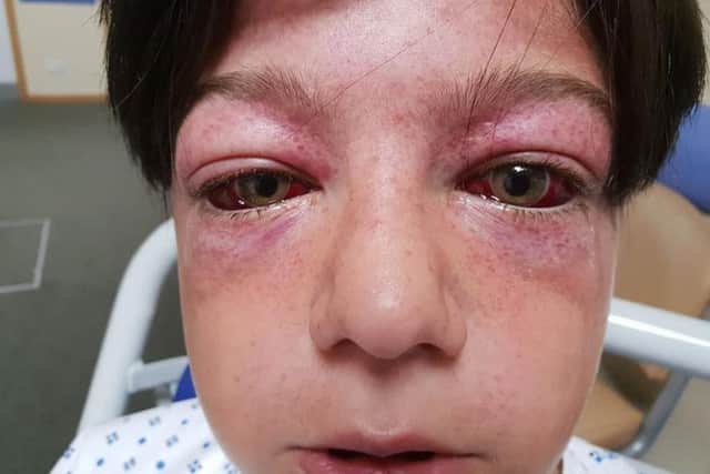 Tyler Broome, 11 was left with possible damage to his brain and vision and with bulging eyes after being found unconscious near a playground roundabout. PIC SWNS