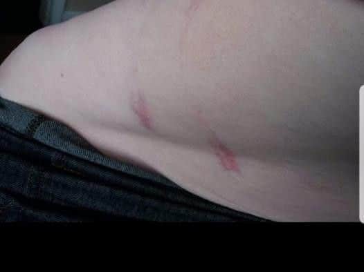 The woman suffered these marks as a result of being hit by the chain.