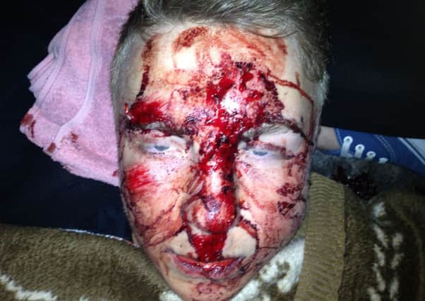Pictured is Chris Hopkinson, 18, of Staveley, who was viciously attacked by two thugs in Creswell.