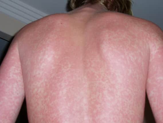 A rash is one of the symptoms of Scarlet Fever