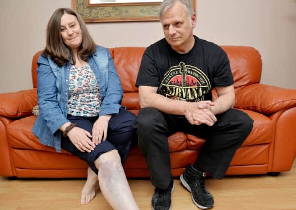 Janice Flint is appealing for witnesses after she was struck by a bus while riding pillion on her husband David's motorbike, Janice shows the bruising to her leg