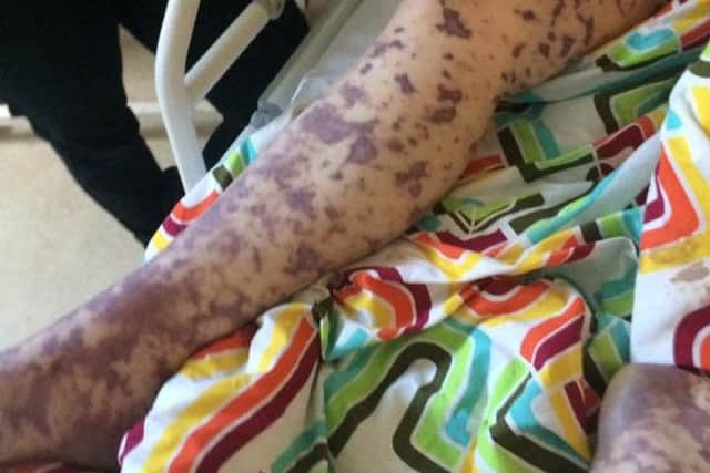 Charlene legs have been badly affected (Photo: Charlene Colechin / Facebook).