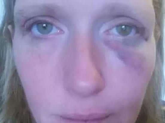 Louise Cowe after the attack. Picture submitted.