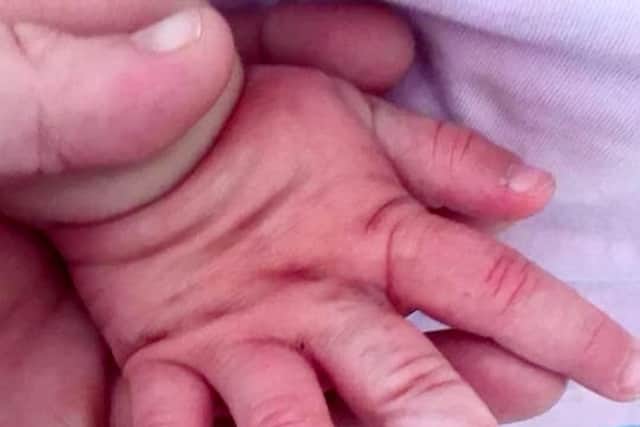 Iiylah-Louise received treatment for tissue damage to the fingers on her right hand. Photo - SWNS