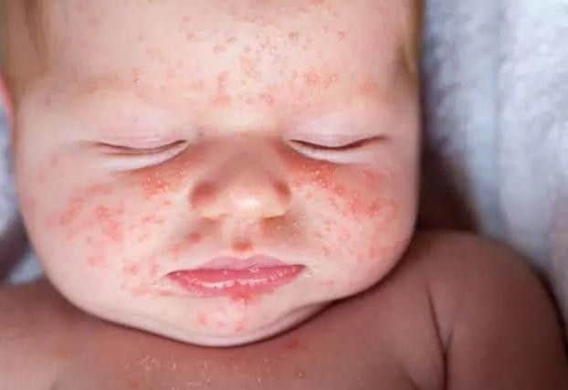 Scarlet Fever rash. Photo: NHS