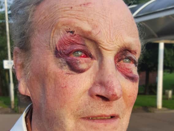 Robert Giles suffered a fractured skull, broken jaw and a broken cheek during the assault.