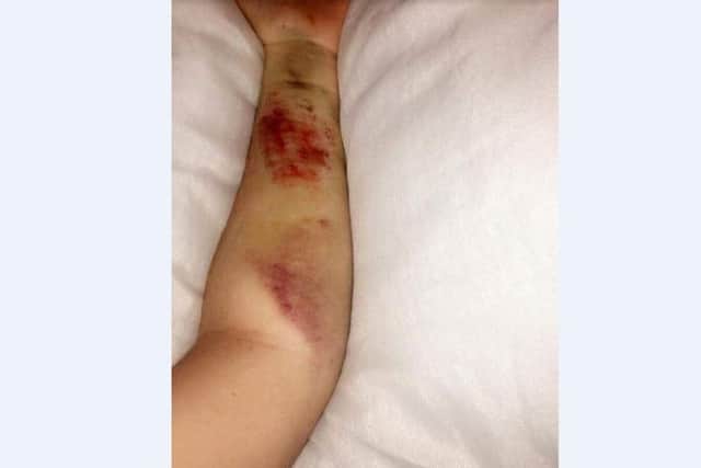Injuries to Katie Hopkinson-Layton's left arm.